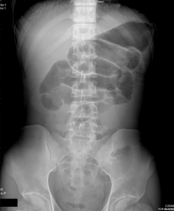 ileus X-ray